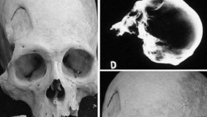 RADIOGRAFIA CRANEO CABEZA
