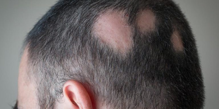 Recuperar el Cabello: Aprueban la primer pastilla para combatir la alopecia y así funciona