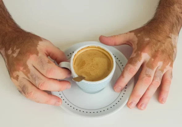 Vitiligo: una condición que provoca pérdida de color de la piel